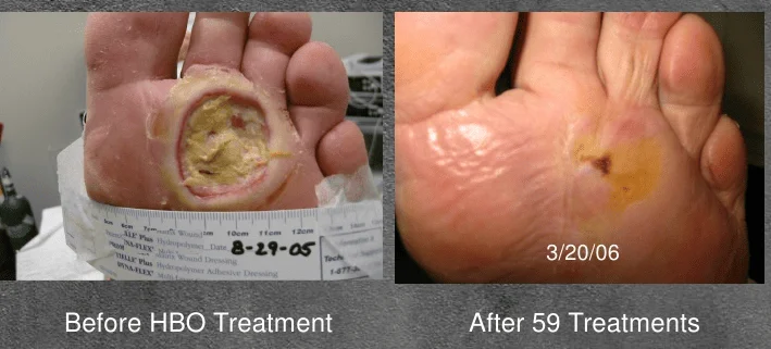 Hyperbaric oxygen therapy