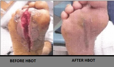 Hyperbaric oxygen therapy